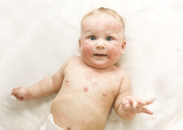 Baby leidet an Neurodermitis | © panthermedia.net /Olegkalina